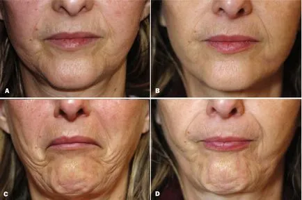 Botox preparate injectabile în formă de corecție buze buzelor Botox