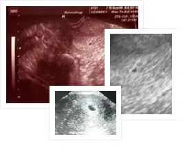 1 hét ultrahang terhesség fotók, az első 1 hét a terhesség