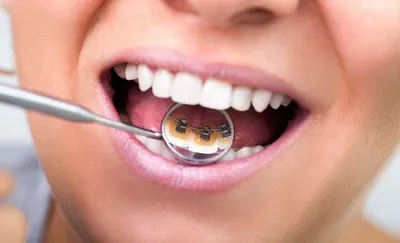 Инсталация на брекети на зъбите