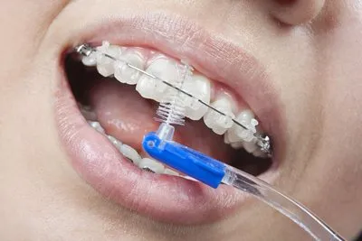 Инсталация на брекети на зъбите