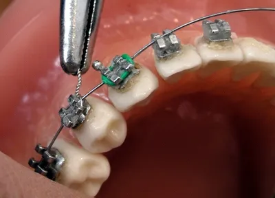 Инсталация на брекети на зъбите