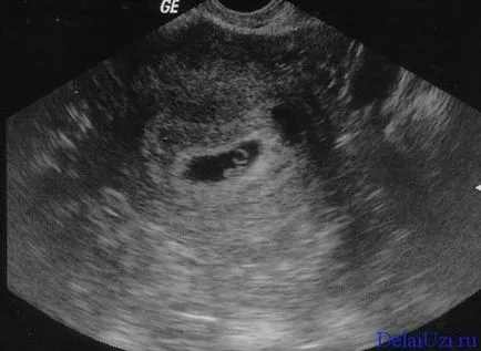 1 hét ultrahang terhesség fotók, az első 1 hét a terhesség