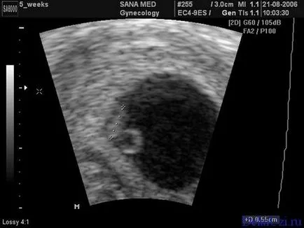 1 седмица ултразвук бременност снимки, първи 1 седмица на бременността