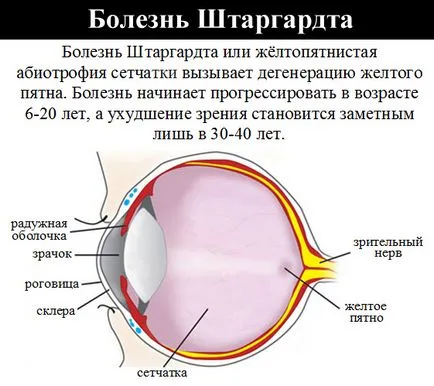 Tratamentul cu succes a bolii Stargardt cu restaurarea vederii, unikamed Clinica - unic