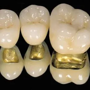 Restaurarea frumusețea și sănătatea dinților folosind coroane dentare