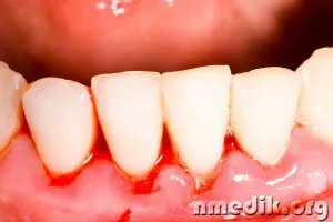 Gum Disease - Prevenirea si tratamentul