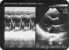 Armata boli cardiace congenitale - tratamentul inimii