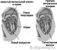 Armata boli cardiace congenitale - tratamentul inimii