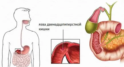 nyombélfekély nemzeti elbánás