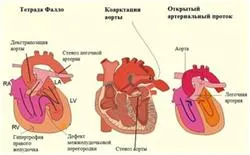 Какъв е видът на аритмия пирует