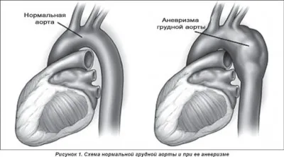 Aneurysm a felszálló aorta tünetek és kezelés