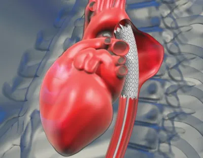 Aneurysm a felszálló aorta tünetek és kezelés