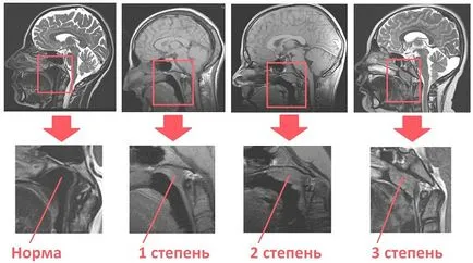 2. fokozat orrpolip gyermekek kezelésére, a tünetek és okok