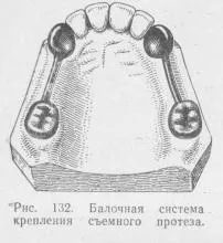 atașament Beam, stomatologie protetice