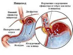 Biliaris reflux esophagitis - tünetek és kezelés