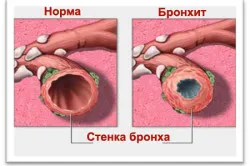 Бронхит или астма как да дефинирате