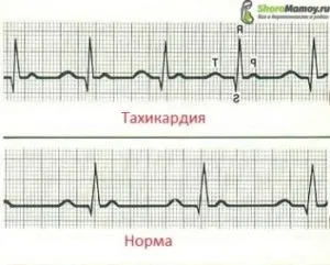 Cinusovaya și tahicardie paroxistică și la naștere
