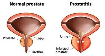 Dr. măcelărie de opinie prostatita si adenom de prostata