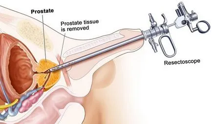 Dr. măcelărie de opinie prostatita si adenom de prostata