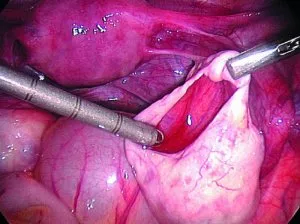 Enucleation на кисти на яйчниците, особено на ефективността и поведението в различните видове образувания