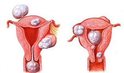 Fibrom uterin cauze, simptome si semne, tratament, o intervenție chirurgicală pentru a elimina