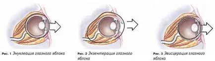 ochi Exenteration metoda de chirurgie scris și