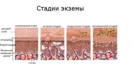 Екзема по ръцете на причините и какви усложнения могат да възникнат