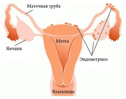 ендометриоза, EUROLAB, гинекология