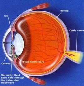 Glaukóma, formái glaukóma, glaukóma