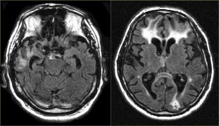 Hydrocephalus és intrakraniális hipertenzió