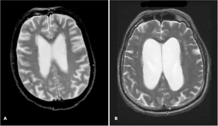 Hydrocephalus és intrakraniális hipertenzió