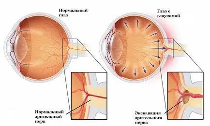 Глаукома око - микрохирургия Федорова