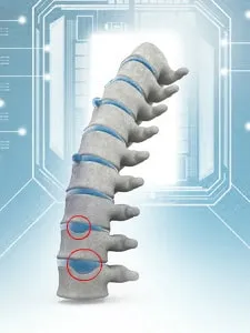 SHmorlja hernie - ce este, cauze, simptome, diagnostic, tratament