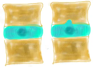 SHmorlja hernie, hernie intervertebrale SHmorlja - tratament, simptome, fotografii