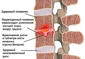 SHmorlja херния, междупрешленните херния SHmorlja - лечение, симптоми, снимки