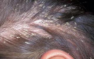 Gombás bőrgyulladás - tünetek és kezelés (fotó)