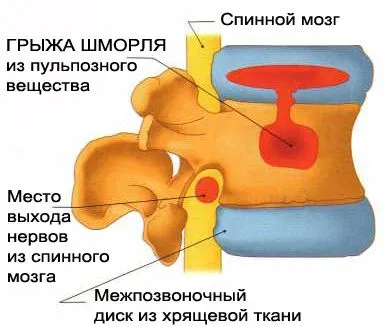 SHmorlja херния, междупрешленните херния SHmorlja - лечение, симптоми, снимки