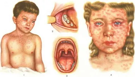 Инфекция и лечение на дерматит, дерматит вирусни причини