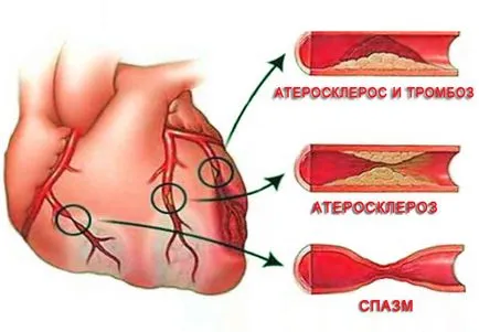 Szívkoszorúér-betegség tünetei, megelőzése, kezelése, diagnózisa, a népi gyógyászat