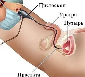 Hogyan cisztográfia húgyhólyag és a vese gyermekeknél és felnőtteknél