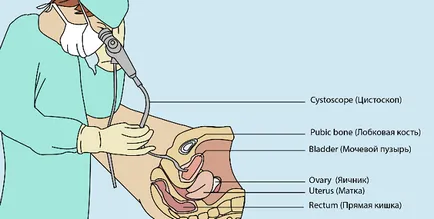 Cum este cistografia vezicii urinare și rinichi la copii și adulți