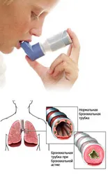 Hogyan lehet megkülönböztetni bronchitis asztma