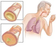 Hogyan lehet megkülönböztetni bronchitis asztma