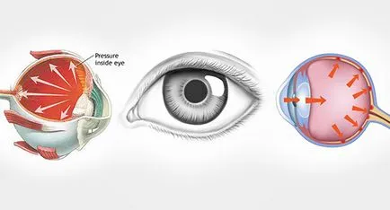 Как е лечението на глаукома с отворен ъгъл, очно заболяване, за