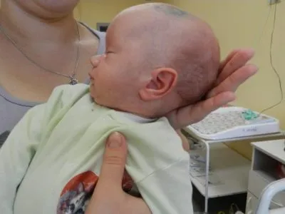 Belső nyitott kommunikáció hydrocephalus agy