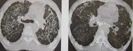 Posibilitățile de tomografie computerizată în diagnosticul tuberculozei pulmonare, pagina 3