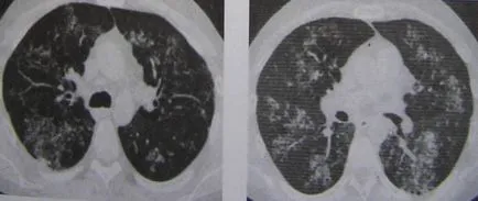 Posibilitățile de tomografie computerizată în diagnosticul tuberculozei pulmonare, pagina 3