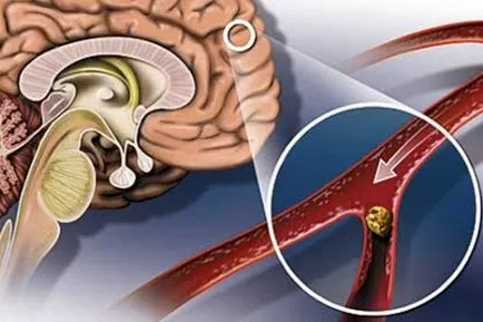 Cum de a îmbunătăți fluxul sangvin cerebral - longevitate sanatoasa