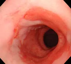 Catarală (suprafață) esofagitei esofagului H3, simptome insuficienta cardia si tratament