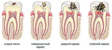 cariilor dentare la copii și adulți, tratamentul, prevenirea, etapa cauzele cariilor